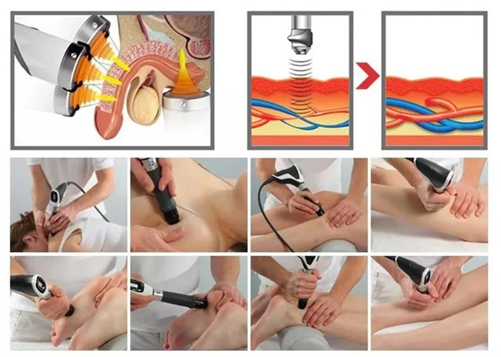 Extracorporeal Shockwave Therapy