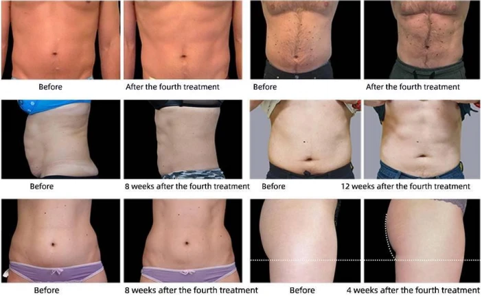 Portable EMSculpt Machine – Build Muscle & Burn Fat Anytime, Anywhere price